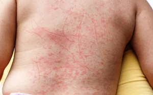 Gia tăng số ca sốt xuất huyết có dấu hiệu cảnh báo ngay từ đầu mùa dịch