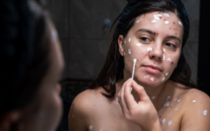 Thủy đậu: Bệnh dễ mắc trong thời tiết nắng nóng