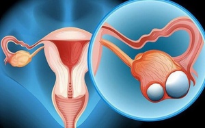 5 nguyên nhân gây u nang buồng trứng cần biết