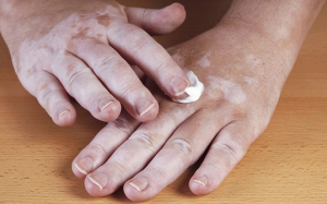 Bệnh bạch biến và giải pháp cải thiện bệnh từ thảo dược