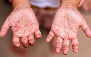 Những điều cha mẹ cần biết khi chăm sóc con bị tay chân miệng