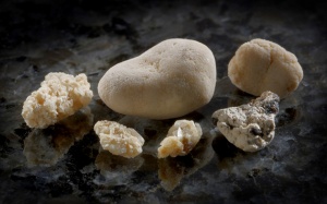 Sỏi túi mật 40mm có nguy hiểm không, chữa bằng ERCP được không?