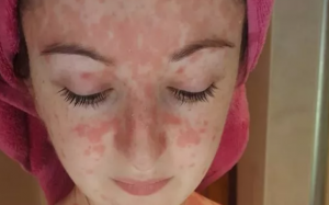 Cách kiểm soát bệnh vảy nến ở mặt