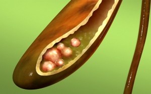 Sỏi túi mật 9mm có nguy hiểm không?