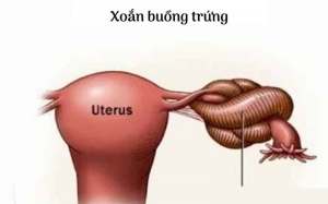 Xoắn hoại tử buồng trứng: Cẩn thận chẩn đoán nhầm