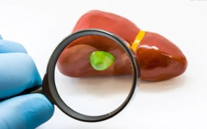 Có 3 polyp túi mật 5mm gây đau bụng, nên điều trị thế nào?