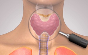 Bướu đa nhân tuyến giáp có nguy hiểm không?