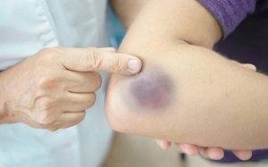 Dấu hiệu ở da cảnh báo ung thư máu, cần đi khám sớm!