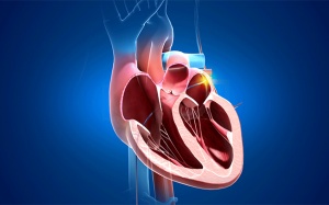 Đốt điện tim điều trị rối loạn nhịp tim có hiệu quả không?