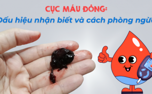 Cục máu đông: Dấu hiệu nhận biết và cách phòng ngừa