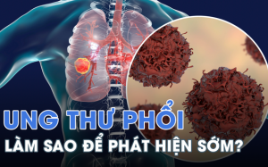 Những triệu chứng bất thường cảnh báo ung thư phổi