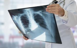 Lượng vitamin K thấp khiến chức năng phổi kém