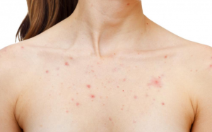 Cách giảm mụn ở ngực tại nhà hiệu quả