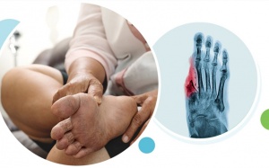 Cách phòng ngừa biến chứng bàn chân cho người bệnh đái tháo đường