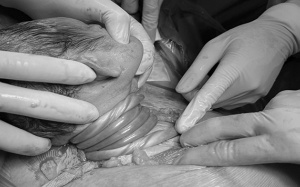 Cấp cứu kịp thời một trường hợp suy thai cấp do dây rốn quấn cổ 5 vòng