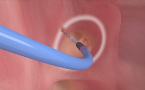 Tại sao không nên đốt điện tim sớm điều trị ngoại tâm thu?