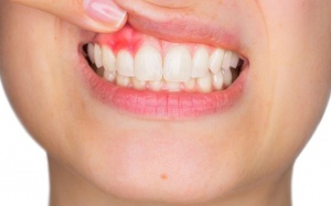 Cách điều trị và phòng viêm lợi tái phát thế nào?