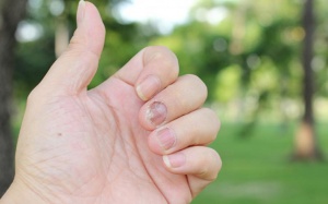 Triệu chứng vảy nến móng tay qua từng giai đoạn