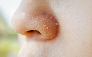 Cách giảm khô da quanh mũi hiệu quả