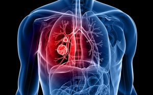 Ung thư phổi không tế bào nhỏ phẫu thuật được không?