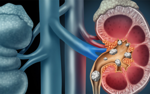 Ngăn ngừa suy thận do sỏi thận 