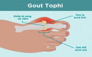 Biến chứng nổi hạt tophi ở người bệnh gout
