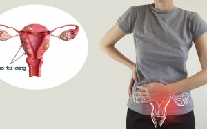 Dấu hiệu u xơ tử cung và cách cải thiện hiệu quả từ thảo dược