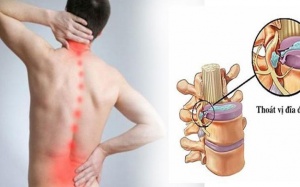 Tiến triển bệnh thoát vị đĩa đệm và giải pháp cải thiện hiệu quả