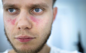 Chế độ dinh dưỡng cho người bị lupus ban đỏ