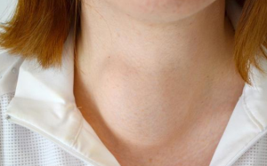 Bướu cổ đơn thuần do đâu và cần phẫu thuật không?