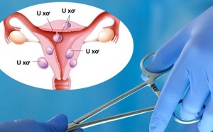 Khi nào cần mổ u xơ tử cung?