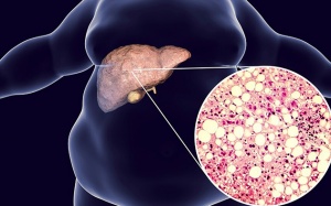 Chế độ ăn giúp phòng, chống bệnh gan nhiễm mỡ không do rượu