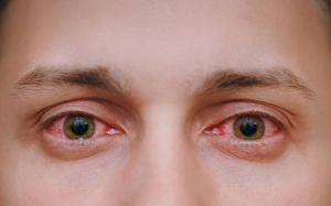 Dịch đau mắt đỏ lây lan cả nước, Bộ Y tế khuyến cáo 5 biện pháp phòng bệnh