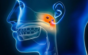 Lưu ý khi chăm sóc người bị ung thư vòm họng 