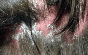 Những ai có nguy cơ mắc bệnh vảy nến da đầu?