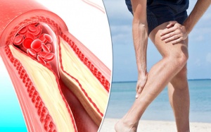 Suýt mất chân do tắc động mạch cấp tính  