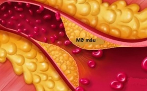 4 hệ lụy nguy hiểm của mỡ máu cao