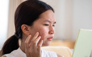 Nguyên nhân gây mụn nang và cách điều trị