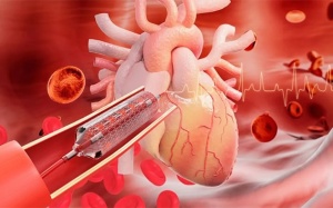Bị suy tim, đã đặt stent có dùng TPBVSK Ích Tâm Khang được không?