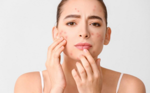 3 điều cần tránh khi da nổi mụn