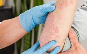 Tìm hiểu về vảy nến thể mủ