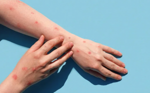 Chỉ trong 1 tuần TP.HCM ghi nhận thêm 6 ca đậu mùa khỉ