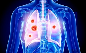 Loại ung thư khiến người mắc có thể tử vong chỉ sau 2 tháng