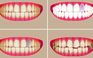 Màu sắc răng tiết lộ điều gì về sức khỏe? 
