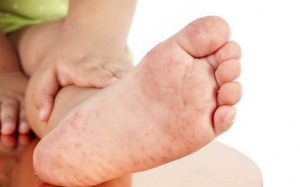 Trẻ bị tay chân miệng độ 1 mấy ngày thì khỏi?