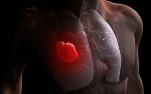 Các triệu chứng của ung thư phổi giai đoạn 3