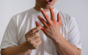 Làm thế nào để kiểm soát nồng độ acid uric ở người bệnh gout?