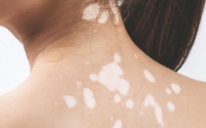 Người bị bạch biến kiêng ăn gì?