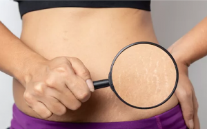 Rạn da có phải vấn đề nguy hiểm?