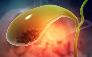 Có nhiều viên sỏi mật 5 - 7mm uống TPBVSK Kim Đởm Khang được không?